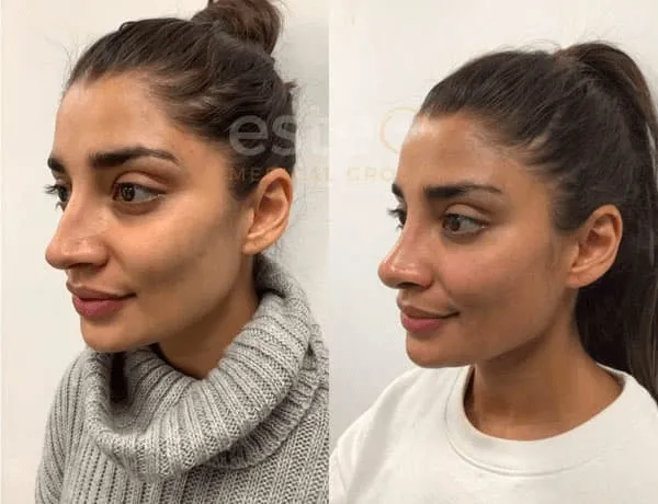 Nose reshaping before and after results