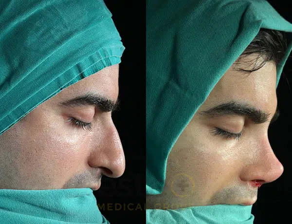 Nose profile improvement before and after results