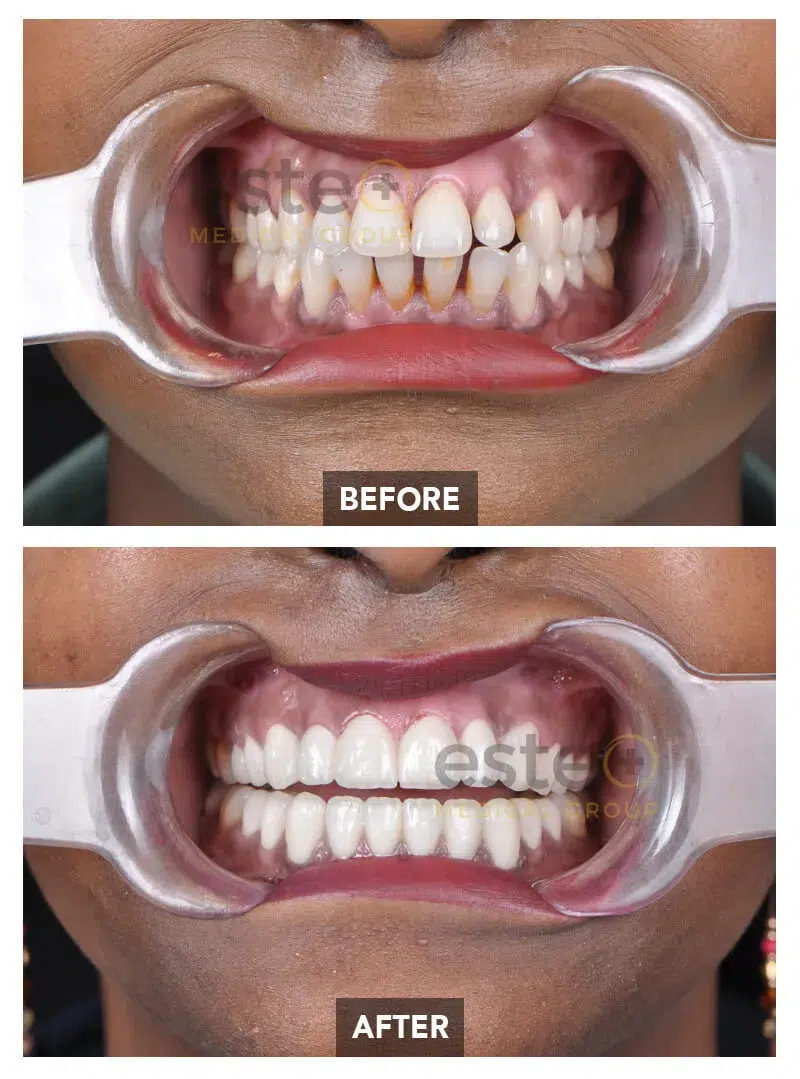 Teeth Whitening Before and after