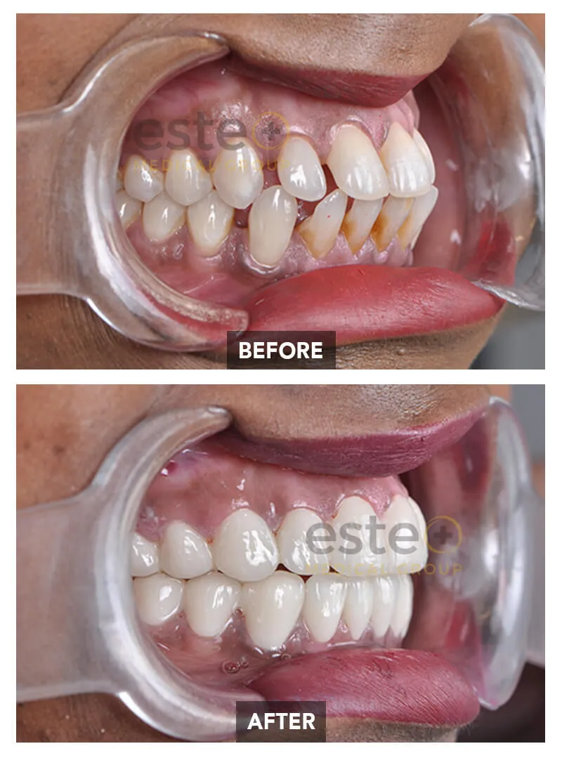 Teeth Whitening Before and after