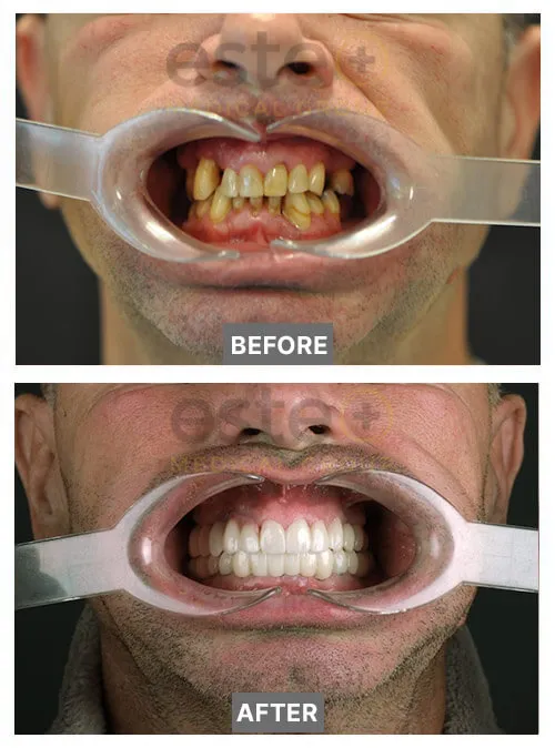 Teeth Whitening Before and after