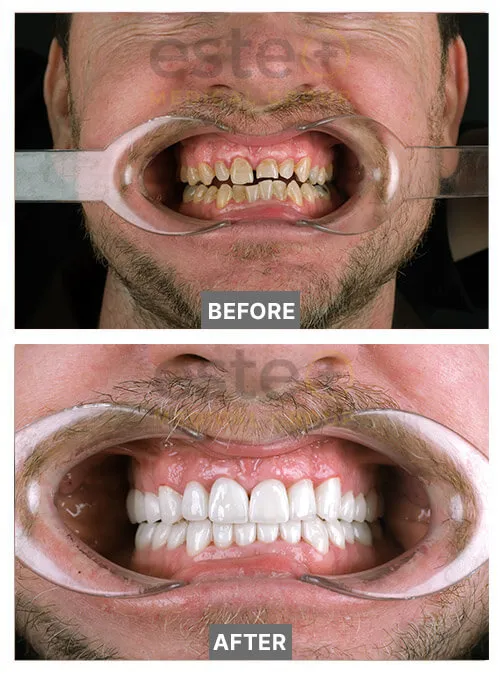 Teeth Whitening Before and after