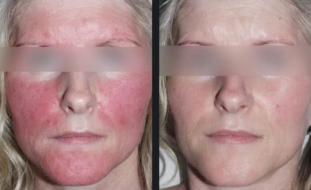 Nordlys Laser Treatment before and after