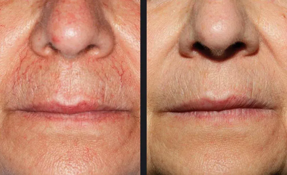 Nordlys Laser Treatment results