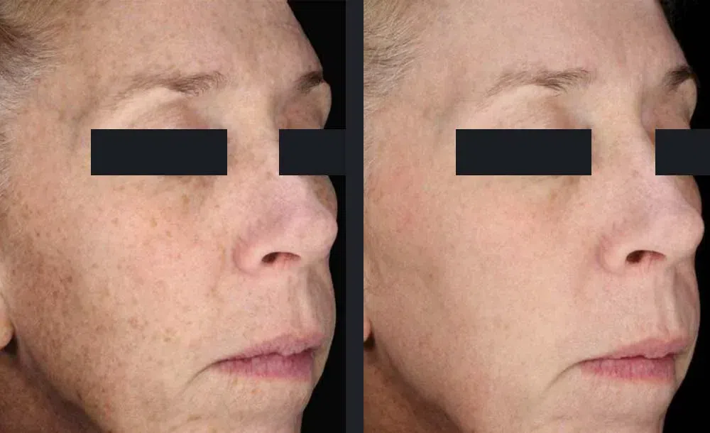 Nordlys Laser Treatment before and after