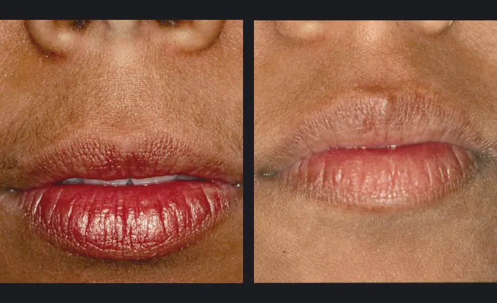 Nordlys Laser Treatment