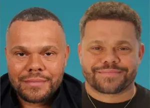 Chris Robotic Hair Transplant Results