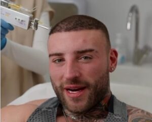 George Irving Post-Hair Transplant: MCT Stem Cell Treatments at Este UK