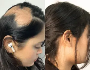 Alopecia before and after