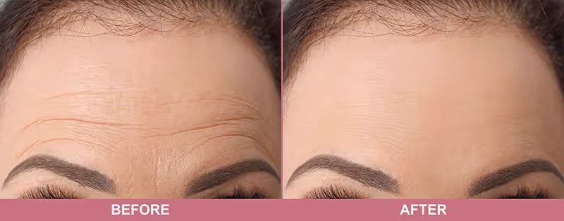 Before and after frown lines treatment