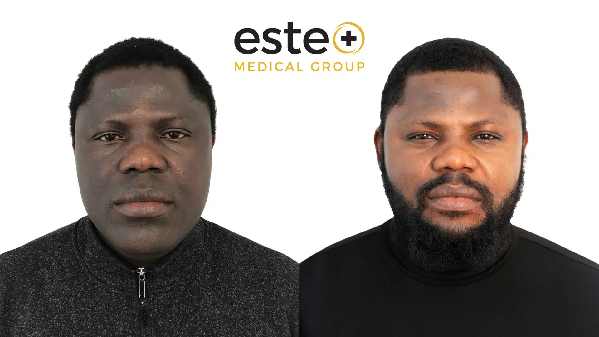 Before and after hyperpigmentation treatment