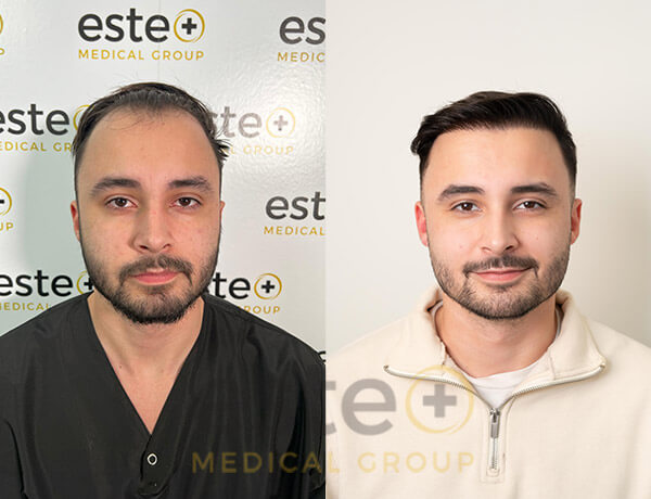 Hair Transplant before and after