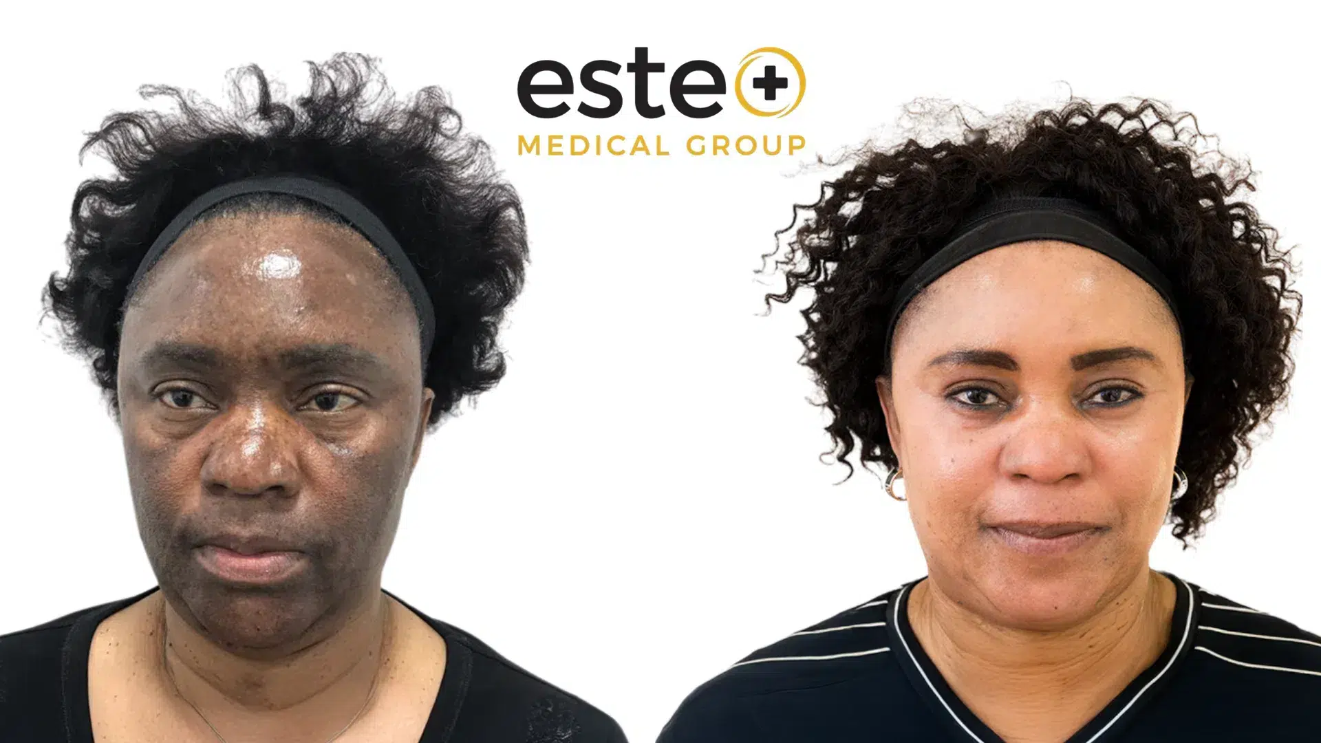 Hyperpigmentation affecting the face