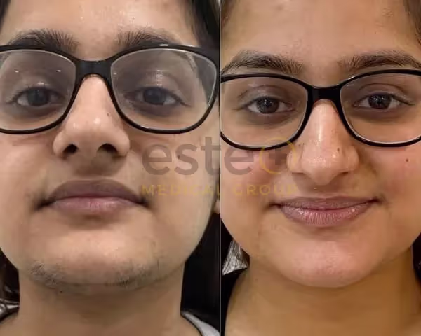 Laser hair removal