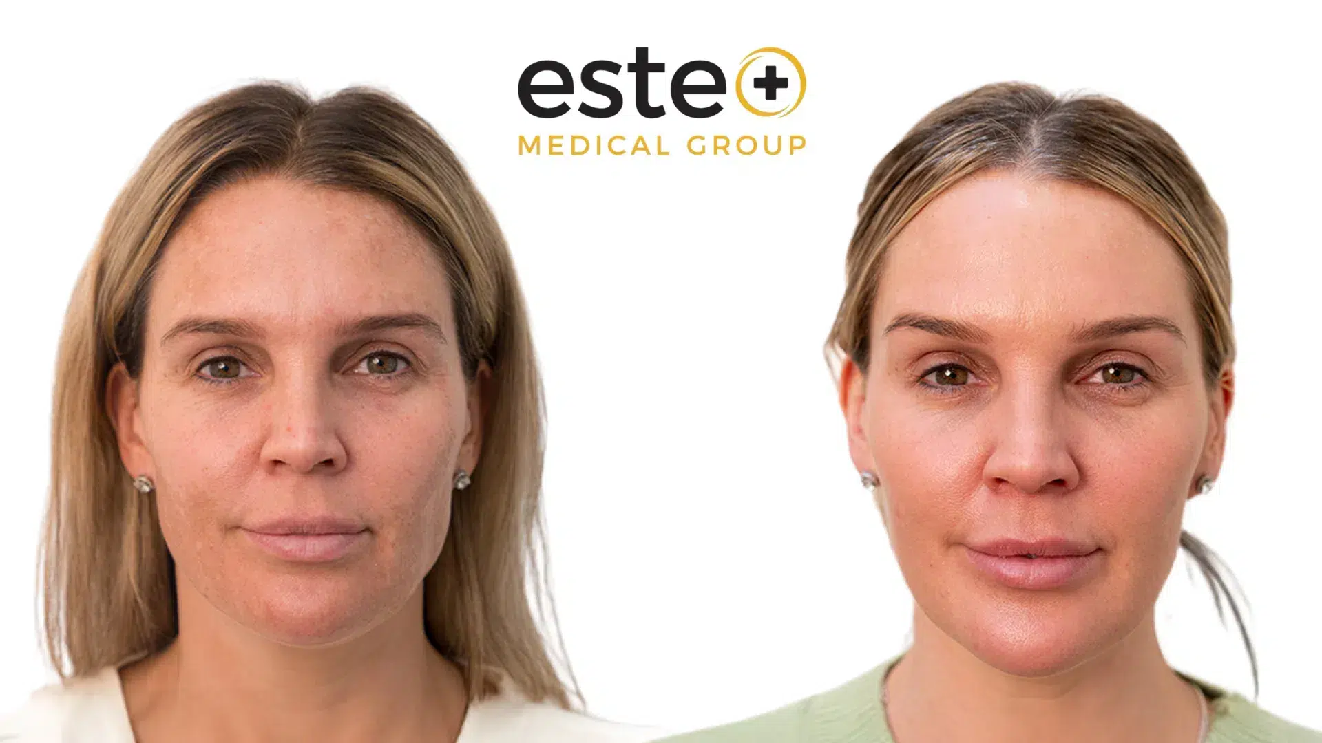 Visible improvement in uneven skin tone after pigmentation treatment.