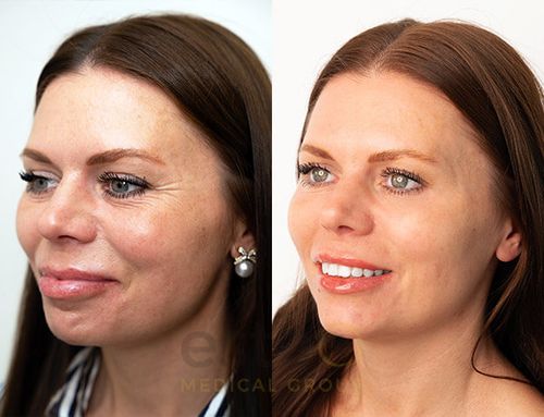 anti ageing treatment result