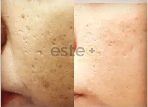 chemical peel