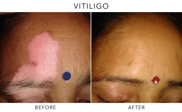 Uneven skin pigmentation caused by vitiligo