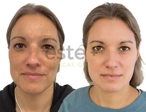 skin pigmentation result