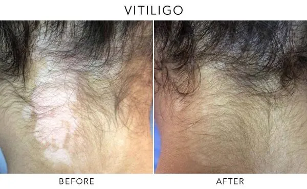 Vitiligo before and after resuslts