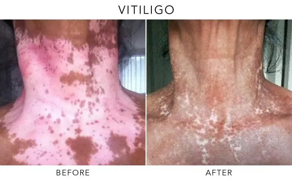 Vitiligo affecting back