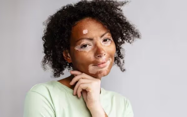 Vitiligo Causes, Symptoms & Treatment Options