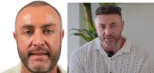 Chris Robotic DHI Hair transplant result
