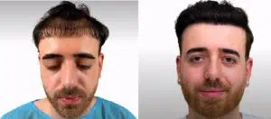 Jack’s 2nd Hair Transplant More Successful After Este UK Robotic Hair Grafts