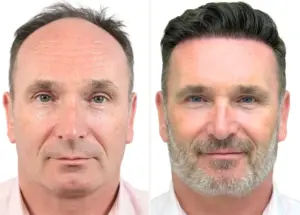 Robotic Hair Transplant