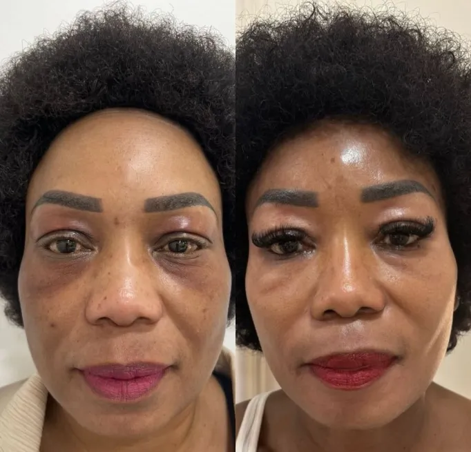 Under-Eye Rejuvenation