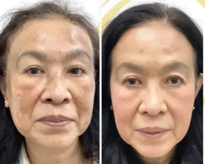 Pigmentation before and after result