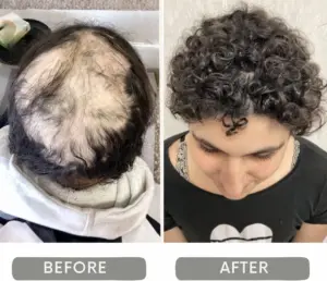 Life-Changing Alopecia Hair Treatment Results