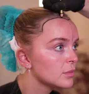 Robotic DHI Hair Transplant