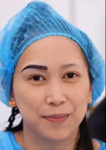 eyebrow transplant results