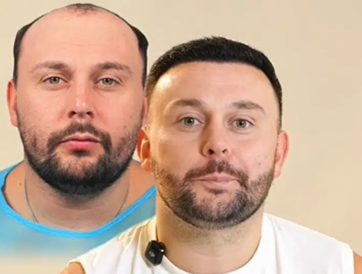 Jamie’s 11,000-Hair Graft Robotic DHI Transplant Results