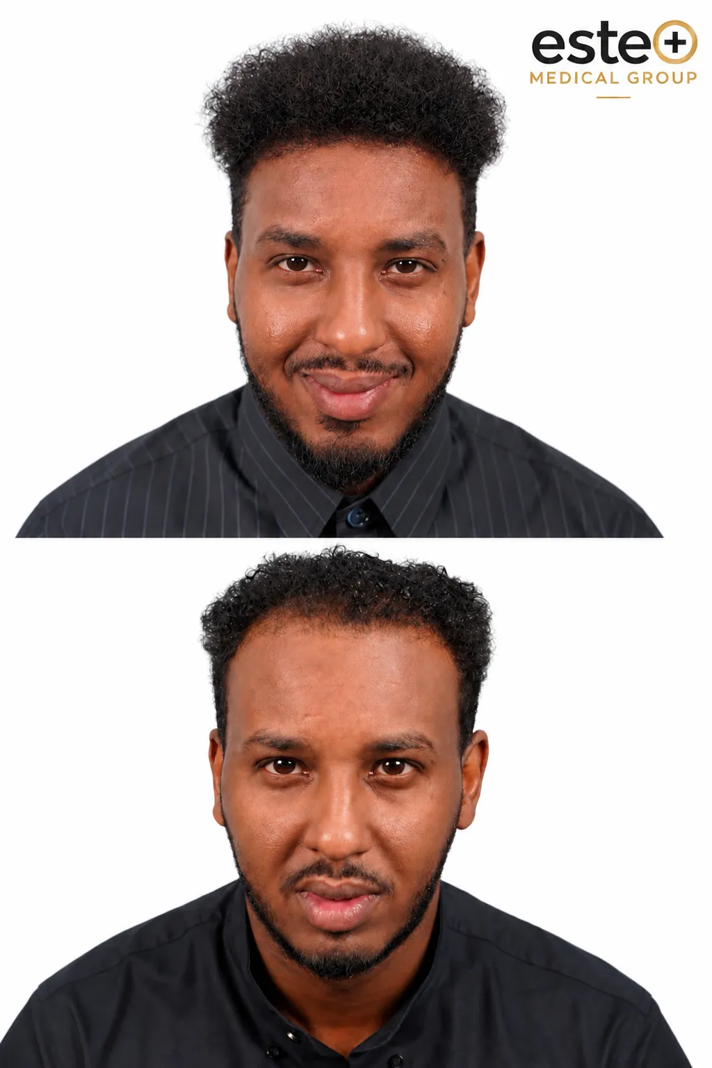 Hair Transplant before and after result