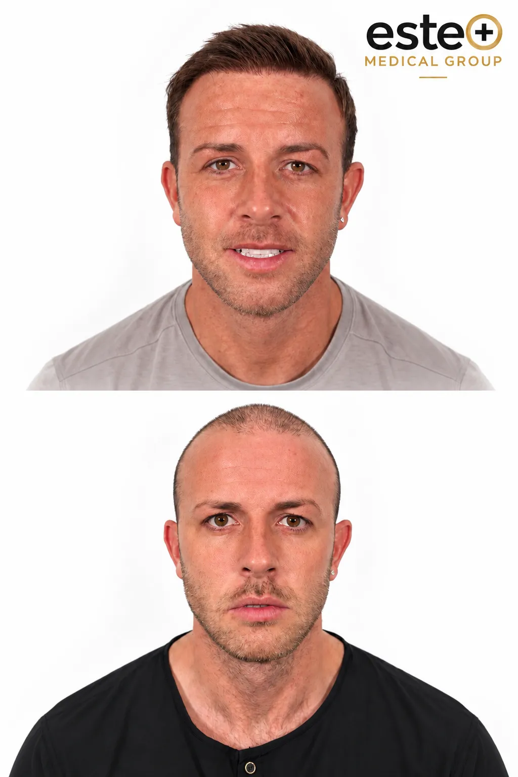 Hair Transplant results