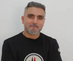 Robotic DHI hair transplant results