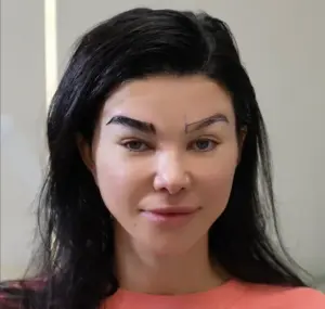 Cheshire eyebrow hair transplant