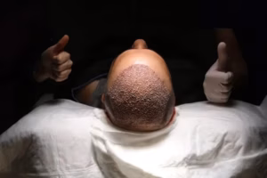 DHI Hair Transplants in Nottingham