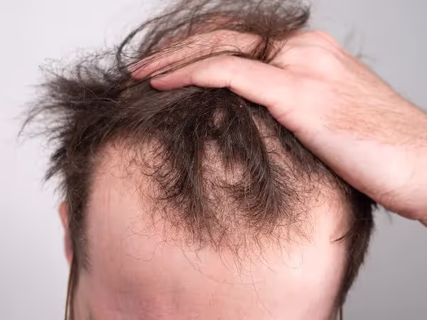 London Hair Transplant Clinic