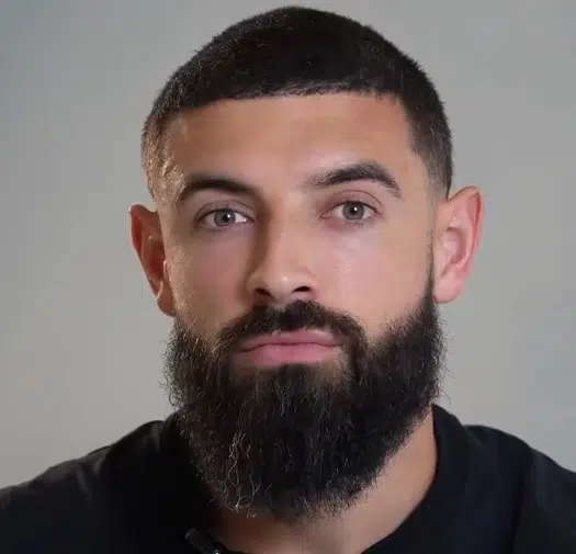 Thomas Hair and beard result with robotic dhi treatment