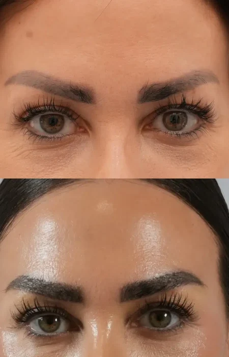 Eyebrow Hair Transplant before and after