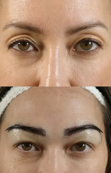 Eyebrow Hair Transplant before and after