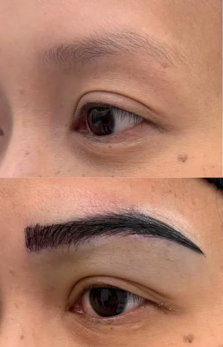 Eyebrow Hair Transplant before and after