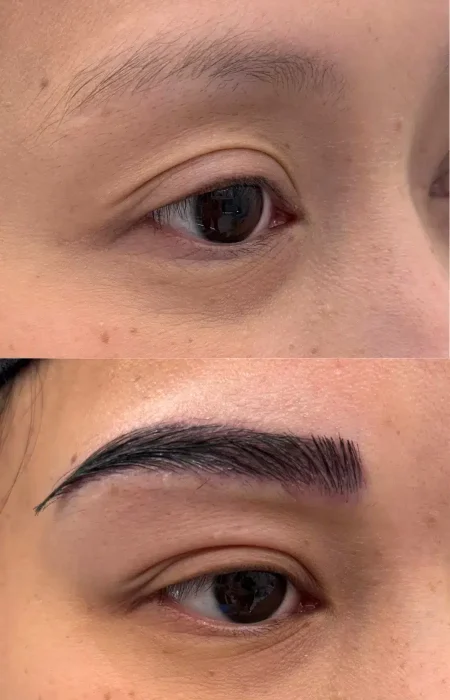 Eyebrow Hair Transplant before and after