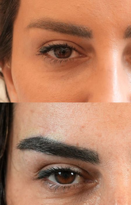 Eyebrow Hair Transplant before and after