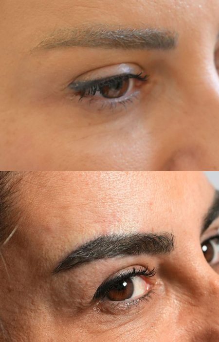Eyebrow Hair Transplant results