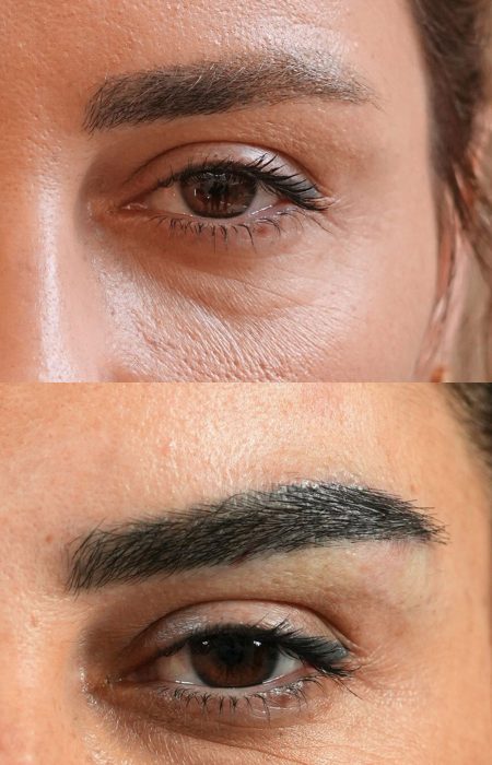 Eyebrow Hair Transplant before and after