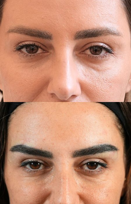 Eyebrow before and after